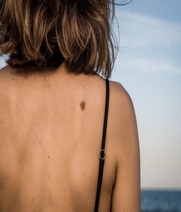 COVID-19 Impact on Melanoma Incidence Trends