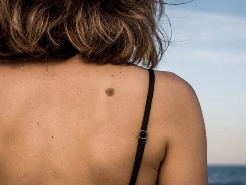 COVID-19 Impact on Melanoma Incidence Trends