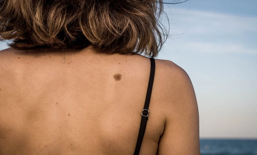 COVID-19 Impact on Melanoma Incidence Trends